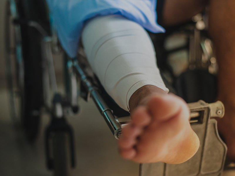 amputation injury lawyer
